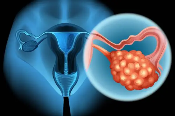 Gynecological Cancer